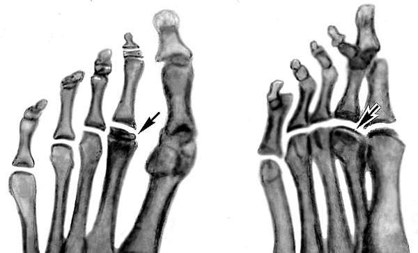 Болезнь Келлера. Остеохондропатия головок II и III плюсневых костей.