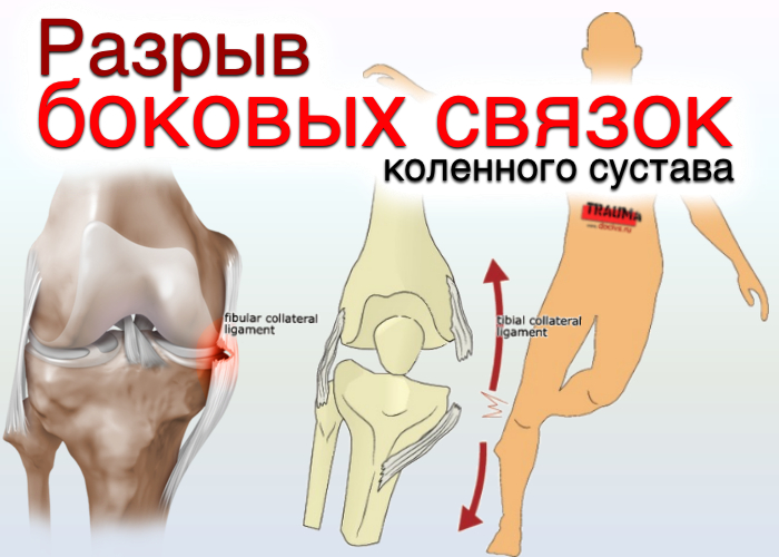 Рис.1. Разрыв боковых связок коленного сустава.